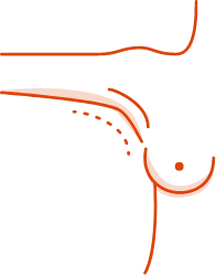 Transaxillary incision