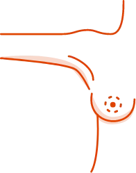 Periareolar incision